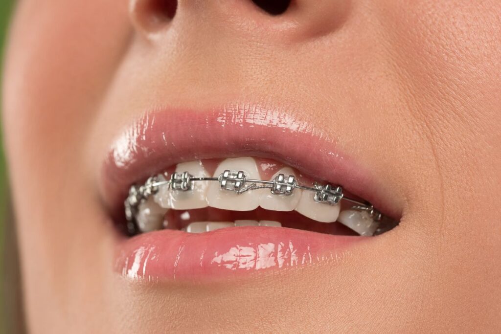 ceramic braces