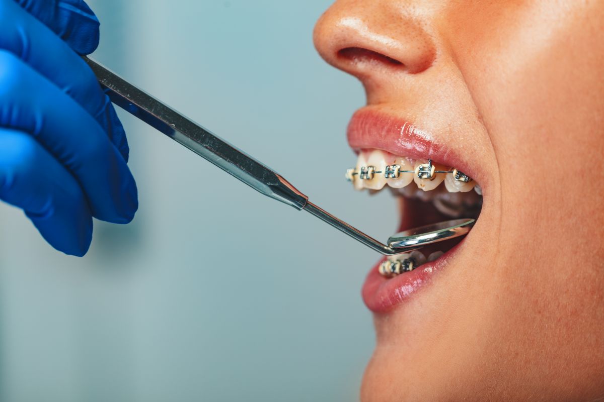 Orthodontist in blue gloves using dental tools to adjust braces on a patient’s teeth (close-up)