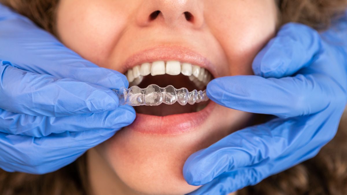 Dental professional in blue gloves fits a clear aligner onto a patient’s teeth in a close-up mouth scene.