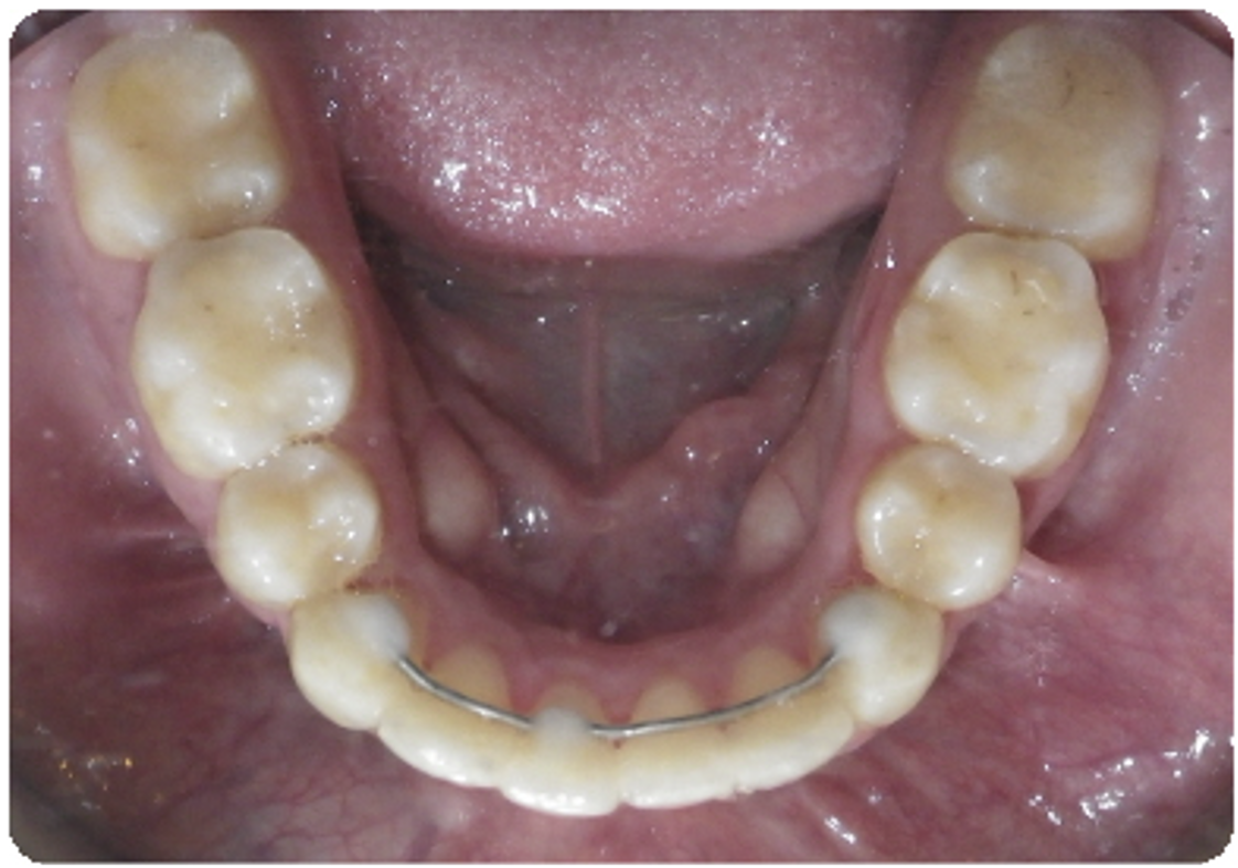 After treatment orthodontic case photo 2