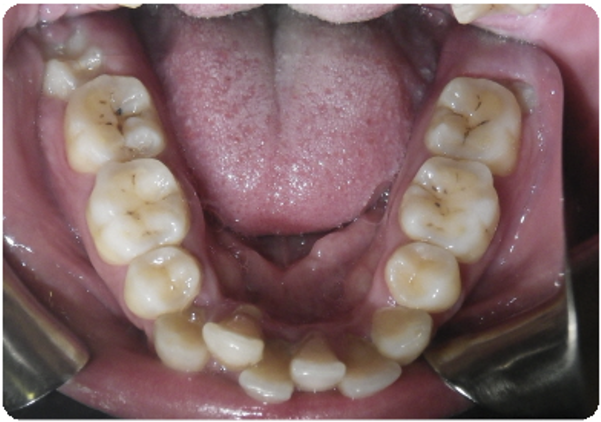 Before treatment orthodontic case photo 2