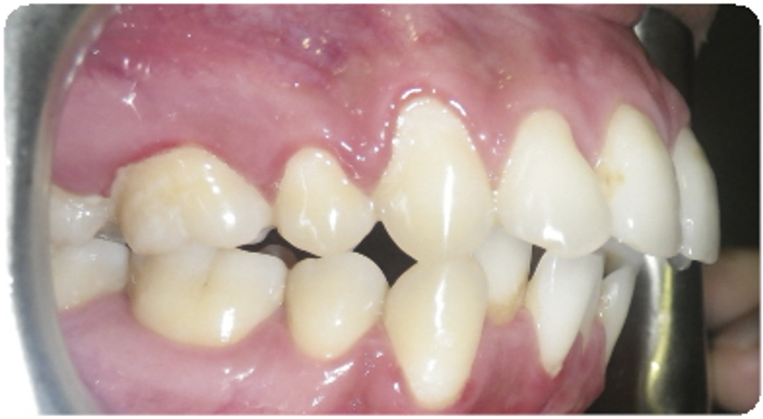 Before treatment orthodontic case photo 3