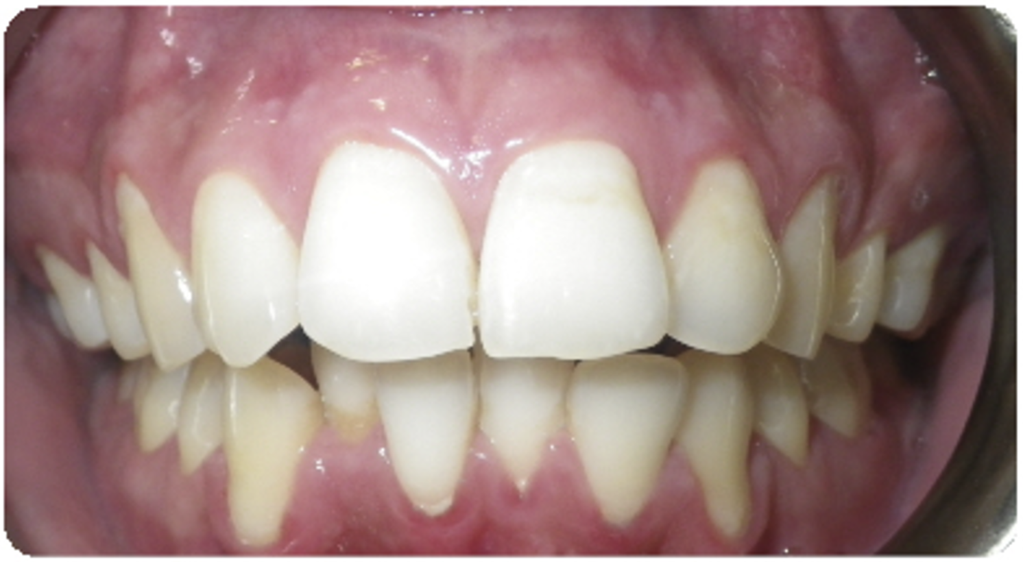 Before treatment orthodontic case photo 4