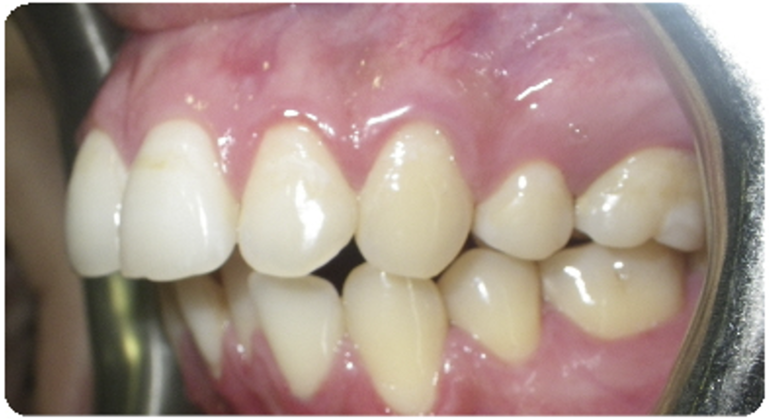 Before treatment orthodontic case photo 5
