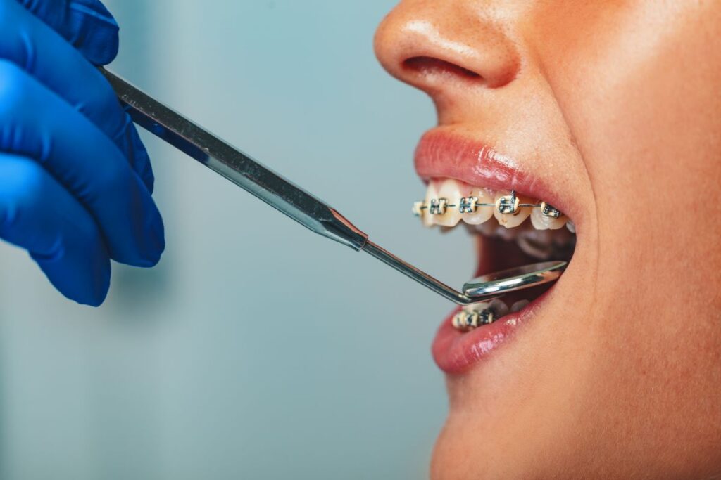 Orthodontist in blue gloves using dental tools to adjust braces on a patient’s teeth (close-up)