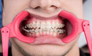 Close-up of a mouth with braces, held open by a pink dental cheek retractor during orthodontic treatment.